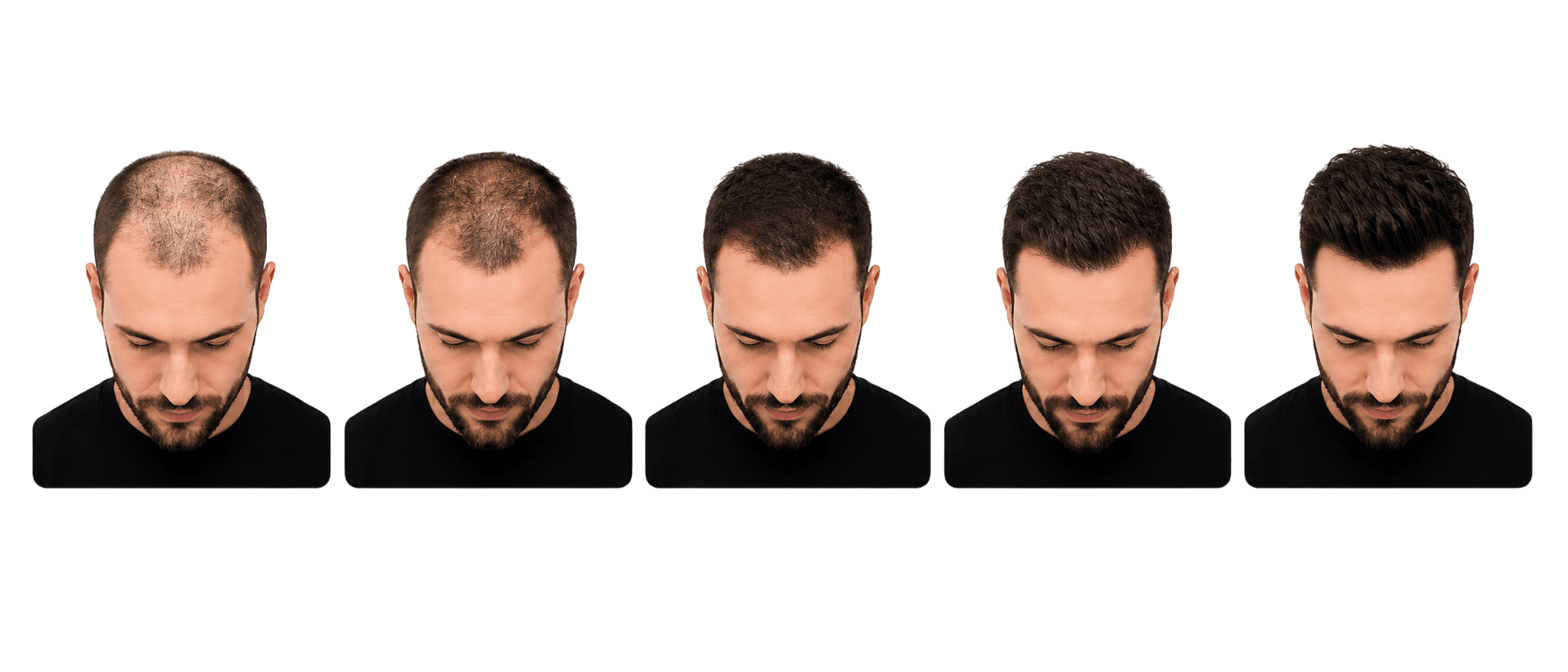 Secuencia visual de crecimiento capilar masculino tras un injerto